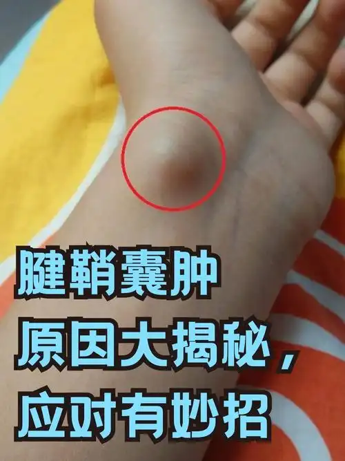 腱鞘囊肿原因大揭秘,应对有妙招