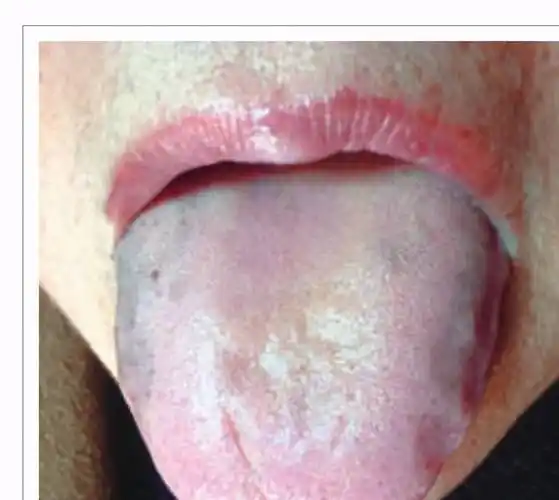 神奇的中医四诊之青紫舌的图片和临床意义