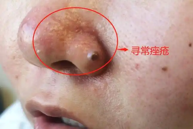鼻子左侧寻常痤疮