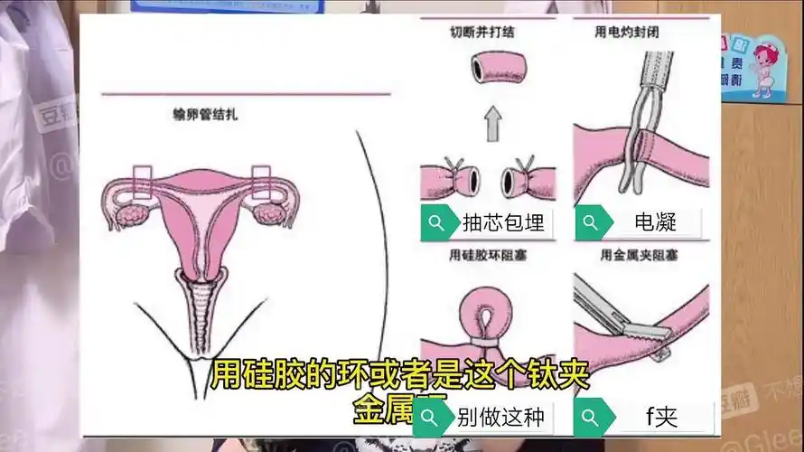 女性输卵管结扎