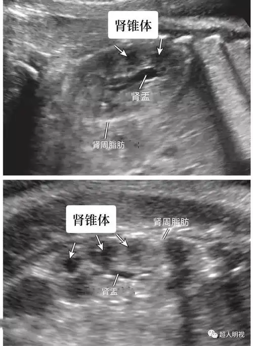胎儿肾脏解剖及大小