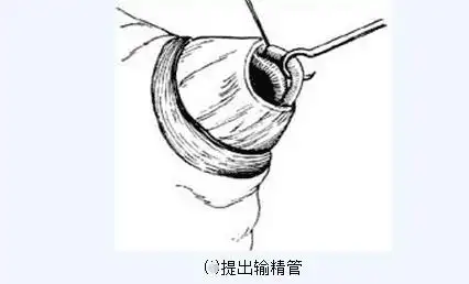 7,分离,结扎输精管:分离出1.