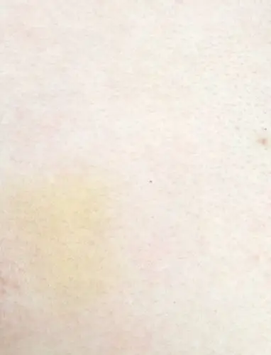 一觉醒来,胸口多了一小块黄斑,没有摔倒过,不痛不痒,与周围皮肤除了