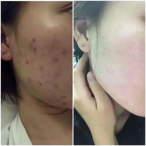 我是这样治好痘痘的|痘龄2 的祛痘经验