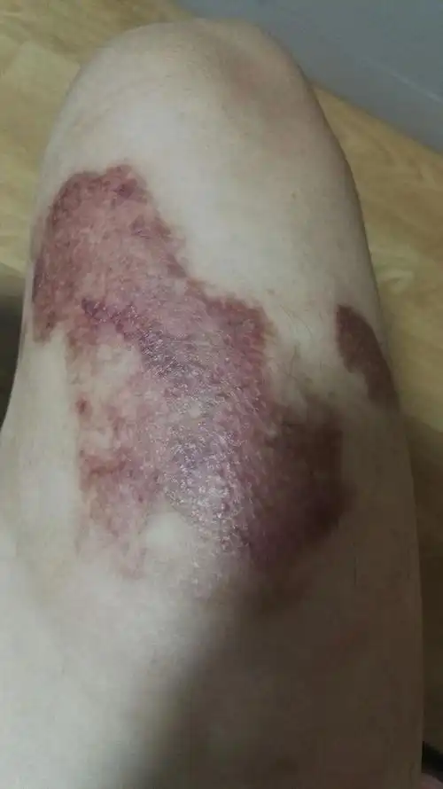 周先生腿部烫伤的治疗与康复