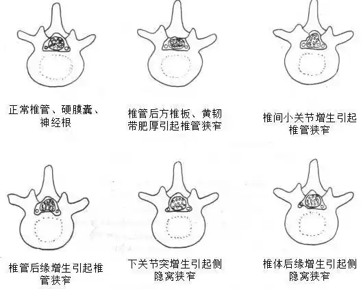 早读 | 腰椎管狭窄症的临床诊治策略