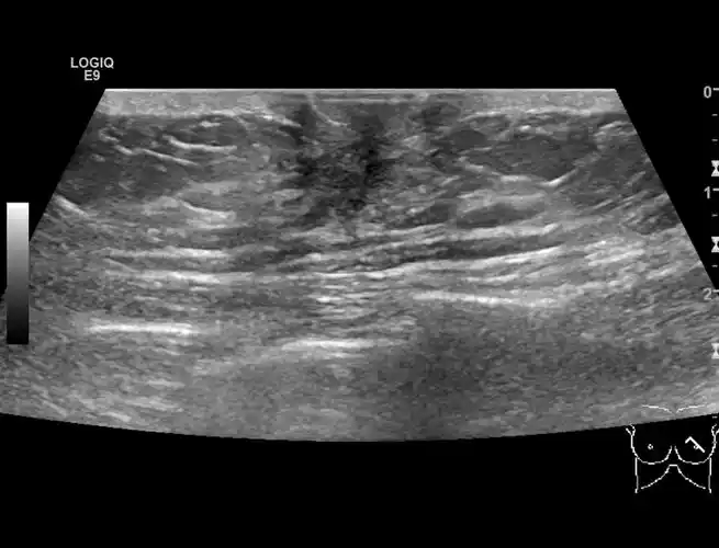 男性乳腺增生症的超声表现