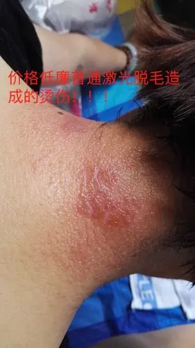 e光脱毛,激光脱毛有什么区别