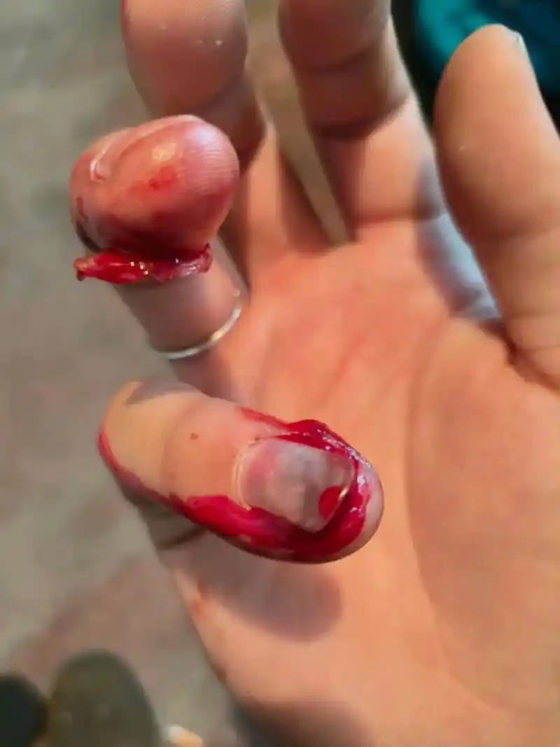 医学影像 #为什么受伤了会流血 骨折 080808 - 抖音