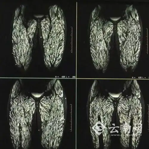 云南一少女常吃生肉全身长满寄生虫(图)