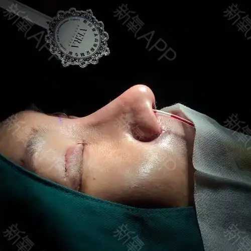 天津假体垫鼻基底好不好_效果图_氧气2pl10假体垫鼻基底术后第0天