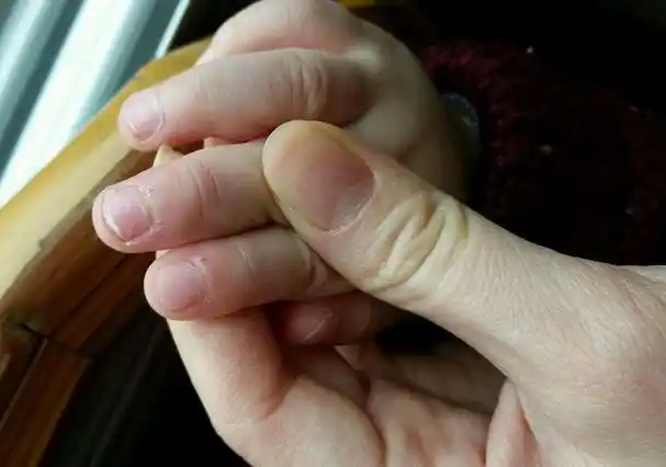 手指长倒刺怎么办?千万别乱拔,这一明星因拔倒刺发炎入院手术