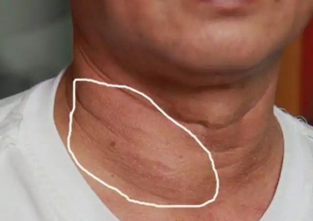 患有甲状腺结节的人,3种"发物"别碰,结节或会慢慢消散_腾讯新闻