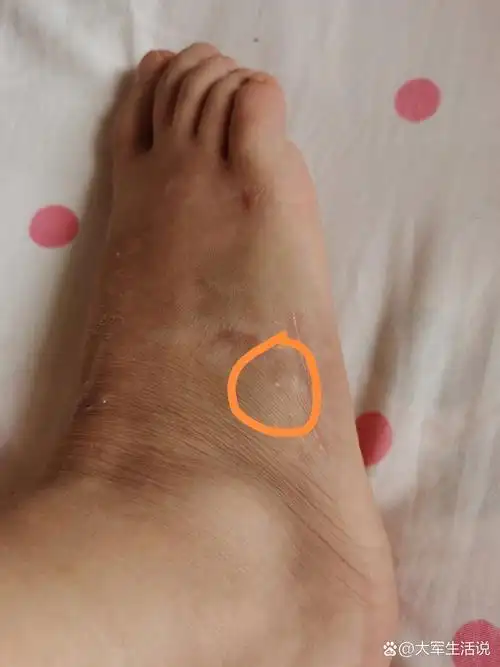 第五跖骨骨折有块骨头凸起 术后70天了 目前拄拐行走,这块骨头凸起来