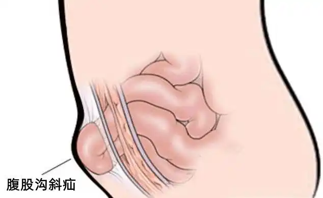 家人送其至市区医院就诊,诊断为右侧腹股沟疝,需要手术治疗,但因老人