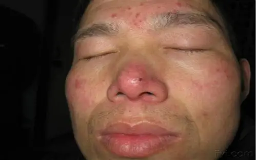 酒渣鼻我家有个红鼻子叔叔