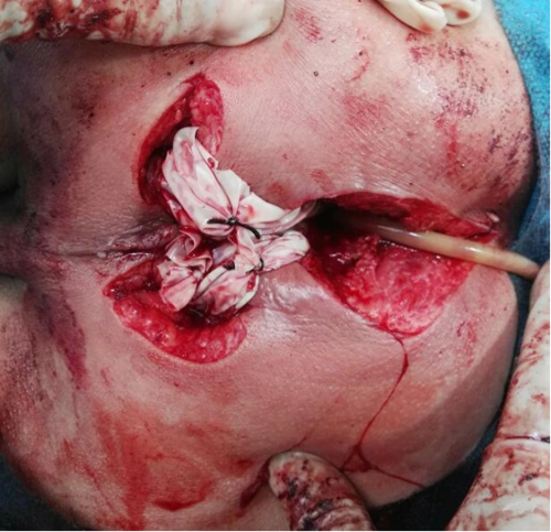 高位肛周脓肿的后位切口