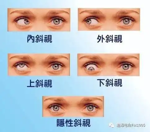 澄海电台保护眼睛预防斜视弱视健康讲座预告