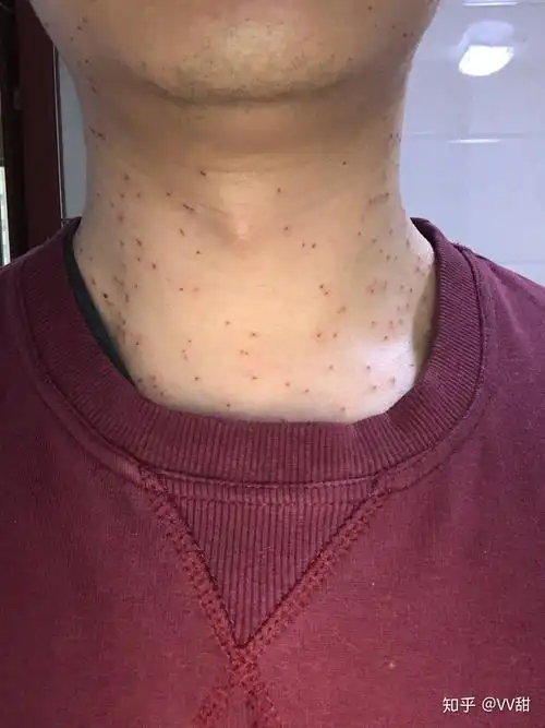 激光点疣记录 - 知乎