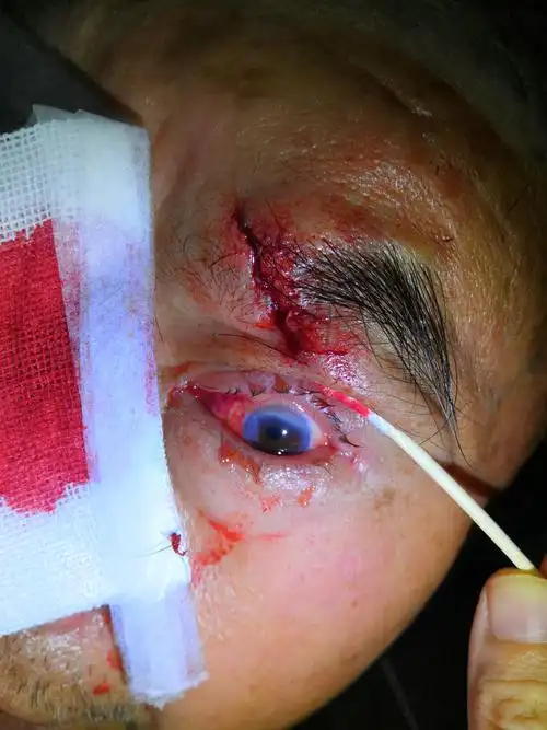 我为患者做眼睑裂伤清创缝合手术术后情况