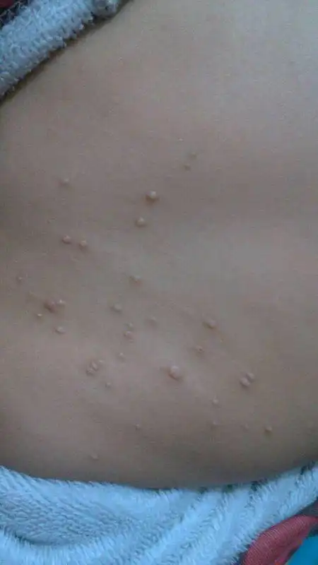 背上有小疙瘩不疼也不痒