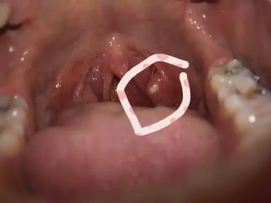 孕妇怀孕七个月喉咙长了白色的颗粒在肉里面,说话很疼,难受,请问医生