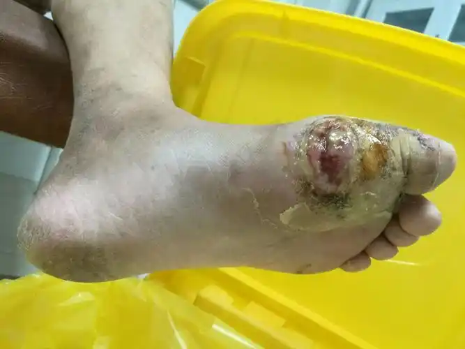 弭希泉,52岁,男性,诊断1型糖尿病12年,自2014年始出现反复左足溃烂