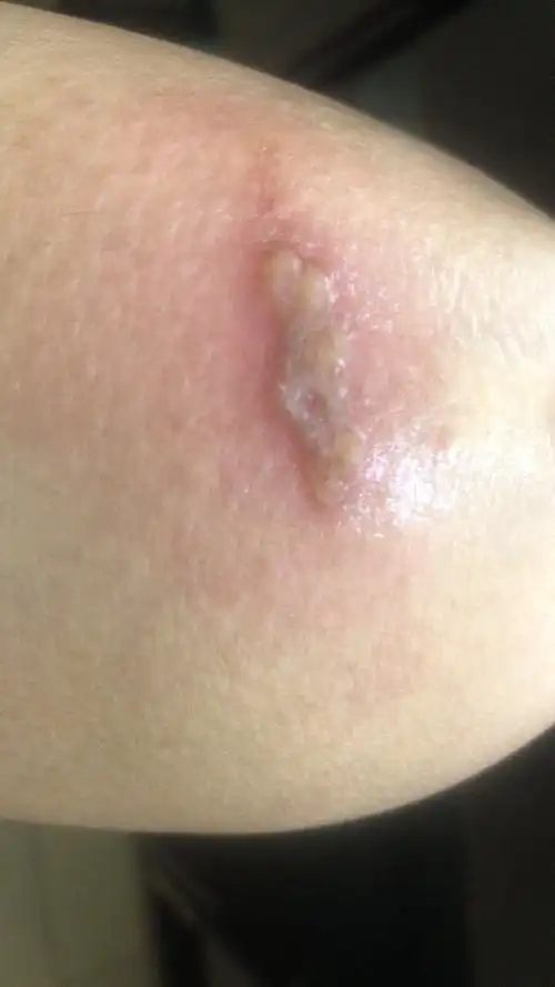 腿部皮肤化脓了