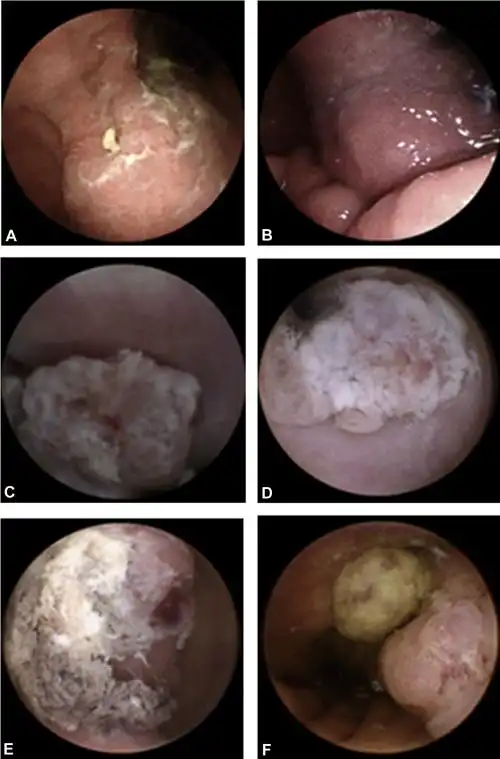 磁控胶囊胃镜--胃癌筛查新利器