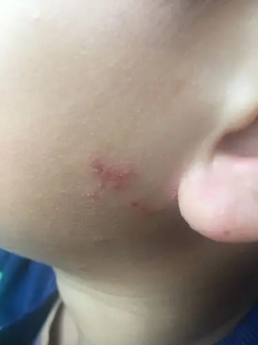 我儿子脸上长了水泡,好像越长越多不知道是怎么回事?
