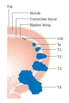tnm分期系统中: t分期(tumor developement)代表肿瘤的发展程度可分