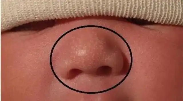 新生儿嘴口粟丘疹