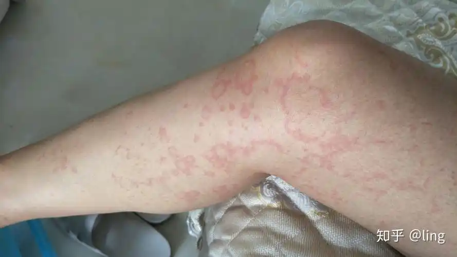 大半夜荨麻疹发作,超吓人