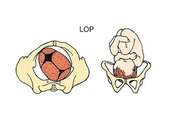 胎位lop能顺产吗了解过lop胎位就知晓如何分娩了