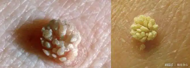 经过进一步感染,逐渐聚集呈乳头状,菜花状,鸡冠状突起