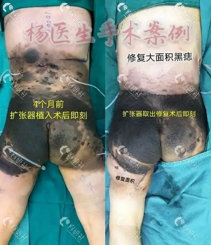 孩子身上有大面积黑痣,哪家医院可以做先天性巨痣症治疗