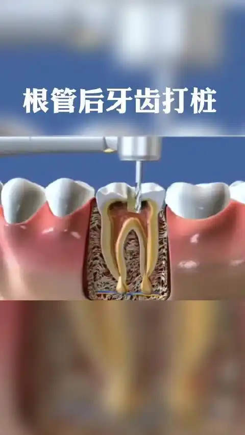 1,给牙齿打桩,是指在牙齿缺损较大,或因为外伤等原因只剩下牙根时,因