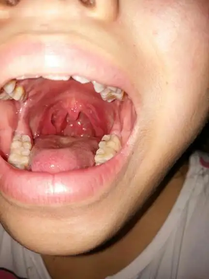 喉咙长得东西好像滤泡咽喉炎,干痒,咳嗽.