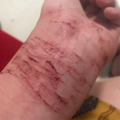 全身都是伤 脸也被打得肿得跟猪头似的 报警后赔了我一万块 昨晚半夜