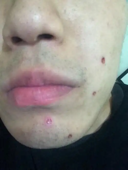 点痣后4天擦嘴的时候把下巴的痂碰掉了,会就疤吗