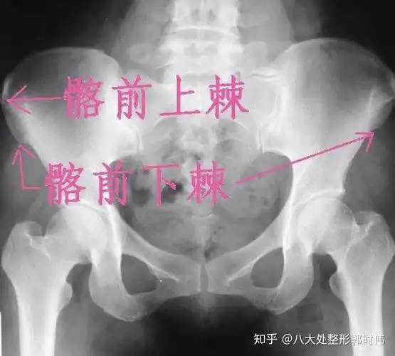 第四:我们要找到髂前上棘(如上图)第三:我们要找到臀沟的最高点.