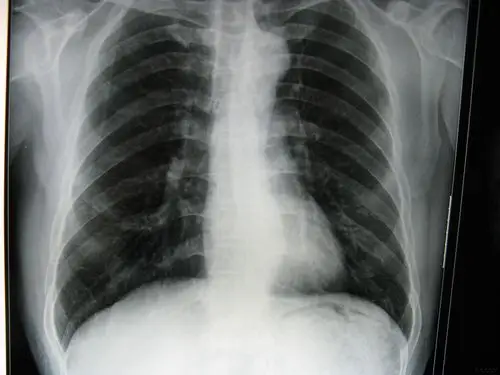 疑难问题,看看这张胸片