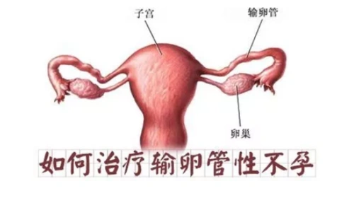 输卵管堵塞是吃药还是手术效果好输卵管堵塞手术治疗方法