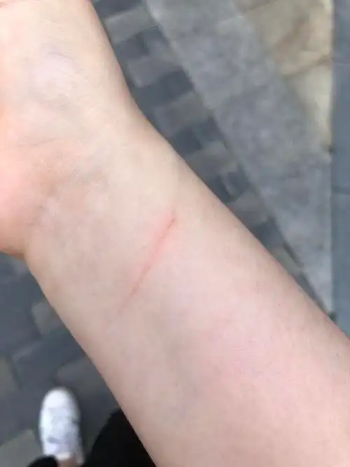 想问一下被狗抓伤了需要去打狂犬疫苗吗?