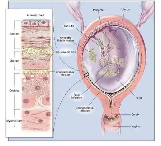 摘要羊膜腔内感染也称为绒毛膜羊膜炎,是指羊水,胎盘,胎儿,胎膜或蜕膜