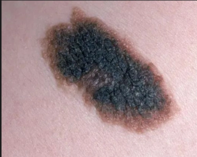 如何判断痣的良恶性