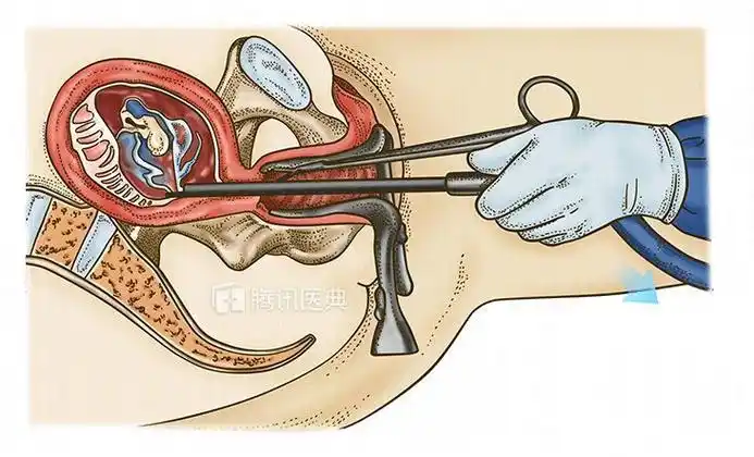 人流对女人子宫的伤害有多大妇科医生揭秘女生都不知道的2大真相