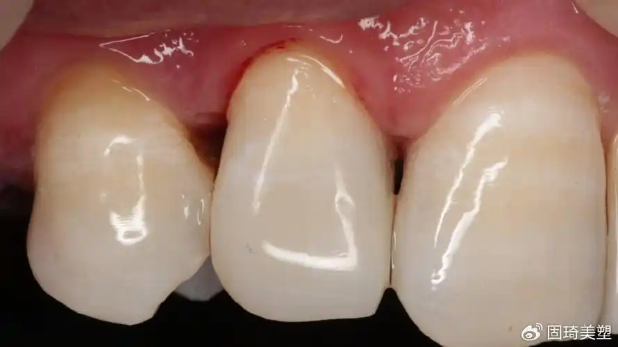 全国30强诞生人气票选开始第三届固琦美塑全国树脂病例大赛