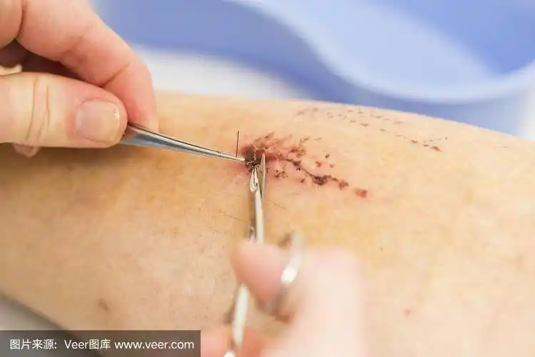 护士正在拆病人腿上伤口上的缝线