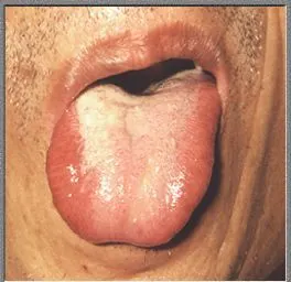 歪斜舌 特征:伸舌时舌体偏向一侧. 意义:中风.